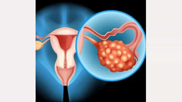 Health News: పొత్తి కడుపులో నొప్పి అండాశయ క్యాన్సర్ లక్షణం.. దీన్ని ఇలా నివారించండి..!