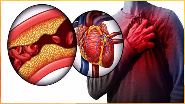 Prediabetes: ప్రిడయాబెటిస్ యువకులలో గుండెపోటు ప్రమాదాన్ని పెంచుతుంది: అధ్యయనంలో సంచలన విషయాలు