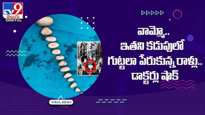 వామ్మో.. ఇతని కడుపులో గుట్టలా పేరుకున్న రాళ్లు.. డాక్టర్లు షాక్ వామ్మో.. ఇతని కడుపులో గుట్టలా పేరుకున్న రాళ్లు.. డాక్టర్లు షాక్
