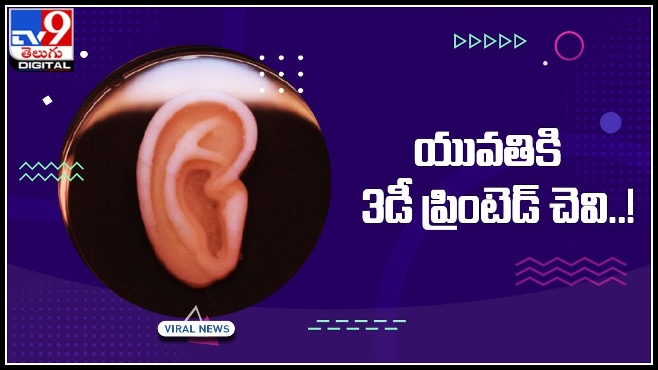 3D printed Ear: యువతికి 3డీ ప్రింటెడ్‌ చెవి..! అమెరికాలో ఆపరేషన్‌ విజయవంతం..