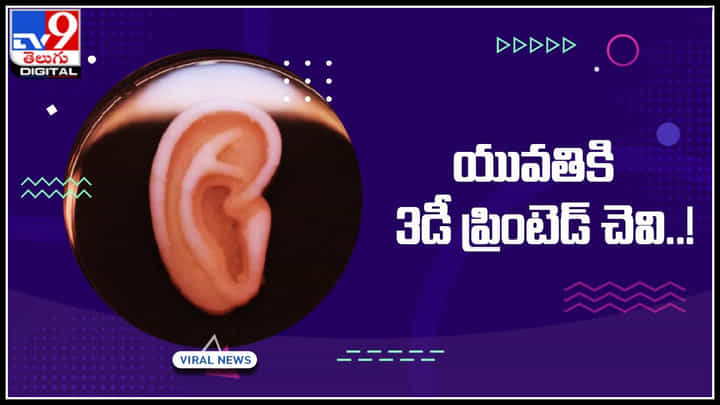 3D printed Ear: యువతికి 3డీ ప్రింటెడ్ చెవి..! అమెరికాలో ఆపరేషన్ విజయవంతం.. 3D printed Ear: యువతికి 3డీ ప్రింటెడ్ చెవి..! అమెరికాలో ఆపరేషన్ విజయవంతం..