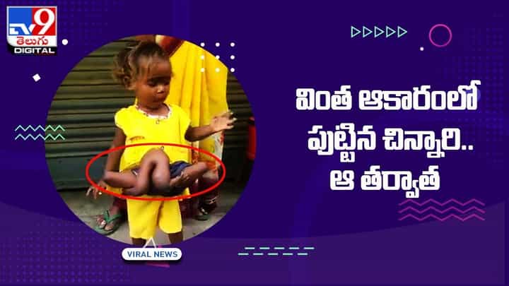 వింత ఆకారంలో పుట్టిన చిన్నారి !! ఆ తర్వాత ?? వింత ఆకారంలో పుట్టిన చిన్నారి !! ఆ తర్వాత ??