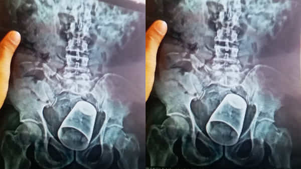 Viral: గ్లాసు ఎక్కడికి చొచ్చుకెళ్లిందో తెలిస్తే స్టన్ అవుతారు.. డాక్టర్లు ఏం చేశారంటే...?