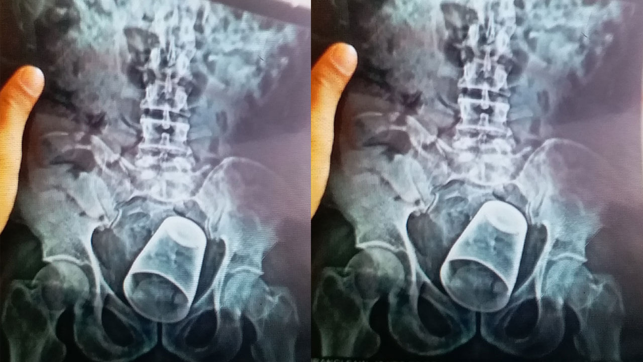 Viral: గ్లాసు ఎక్కడికి చొచ్చుకెళ్లిందో తెలిస్తే స్టన్ అవుతారు.. డాక్టర్లు ఏం చేశారంటే...?