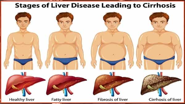 Fatty Liver: ఫ్యాటీ లివర్తో బాధపడుతున్నవారు నెయ్యి తినాలా? వద్దా?.. ఆహార పూర్తి జాబితా ఇదే..