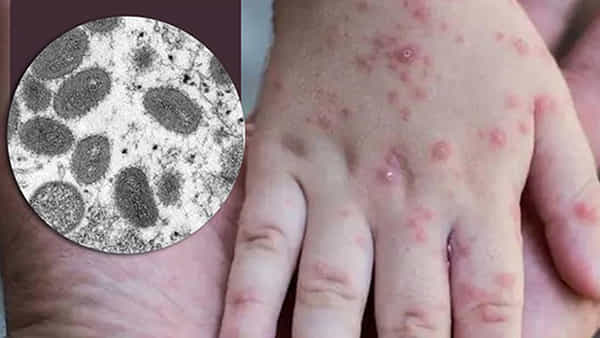 Monkeypox: మరో రాష్ర్టంలో మంకీపాక్స్ కలకలం..! తెలంగాణలో వైద్యశాఖ అలెర్ట్..