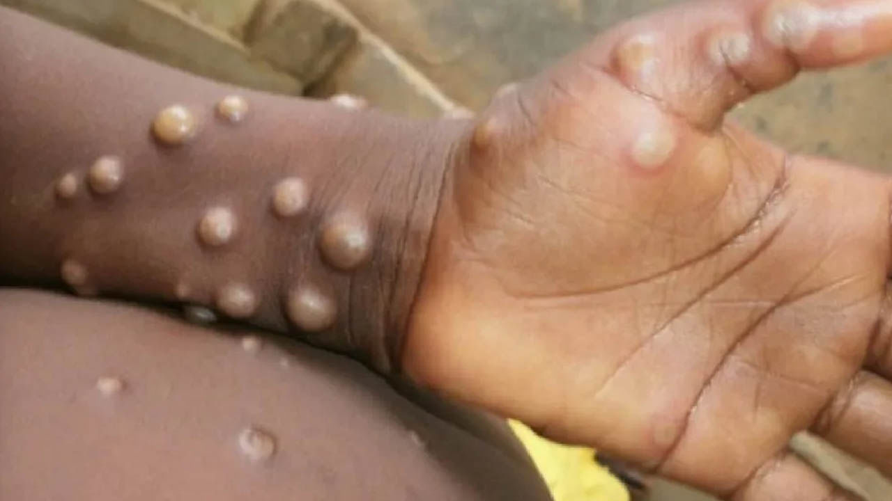 Monkeypox: చాప కింద నీరులా మంకీఫాక్స్.. ఢిల్లీలో 5వ పాజిటివ్ కేసు నమోదు..