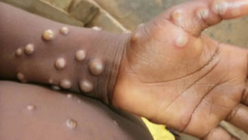 Monkeypox Virus: 29 దేశాల్లో వ్యాపించిన మంకీపాక్స్‌ కేసులు.. మహిళల్లో ఈ వైరస్‌ ఎక్కువే..!