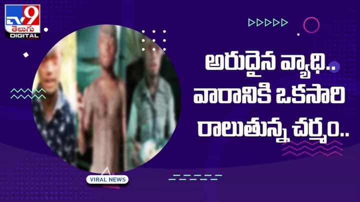 అరుదైన వ్యాధి.. వారానికి ఒకసారి రాలుతున్న చర్మం.. అరుదైన వ్యాధి.. వారానికి ఒకసారి రాలుతున్న చర్మం..