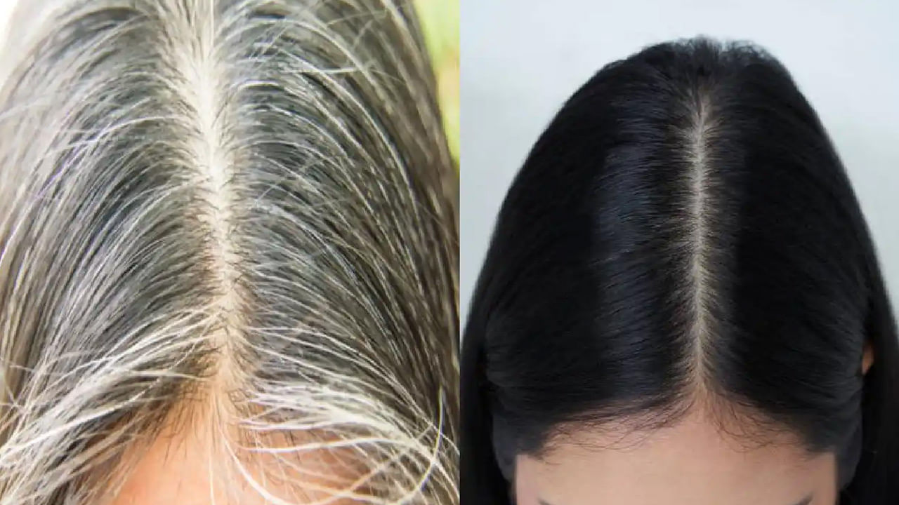 White Hair What Why  How To Reverse Premature Greying  SkinKraft