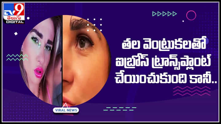 Eyebrow Transplant: తల వెంట్రుకలతో ఐబ్రోస్ ట్రాన్స్ప్లాంట్ చేయించుకుంది కానీ చివరికి.. షాక్..! Eyebrow Transplant: తల వెంట్రుకలతో ఐబ్రోస్ ట్రాన్స్ప్లాంట్ చేయించుకుంది కానీ చివరికి.. షాక్..!