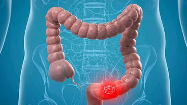 Bowel Cancer Symptoms: మీకు ఈ లక్షణాలు కనిపిస్తున్నాయా..? జాగ్రత్త.. పెద్దప్రేగు క్యాన్సర్ కావచ్చు..!