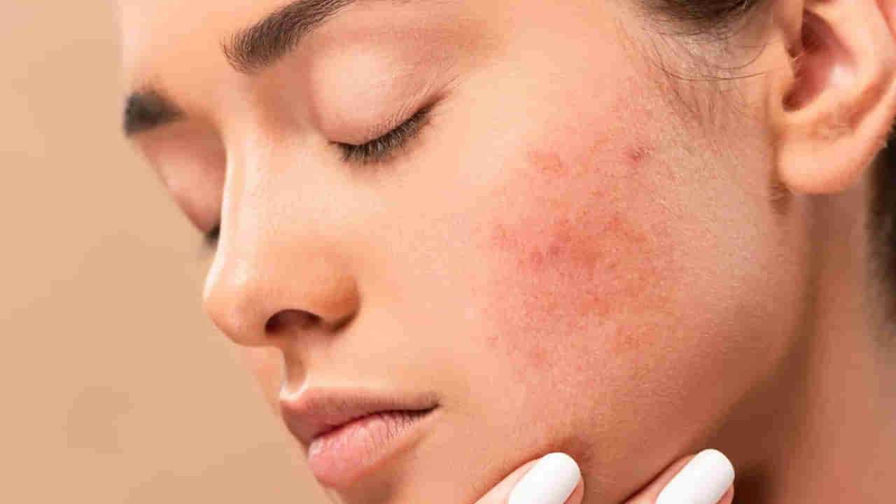 Skin Care: వర్షంలో చర్మం జిడ్డుగా ఉండి.. ముఖంపై మొటిమలు వస్తుంటే.. ఇలా చేస్తే చాలు..