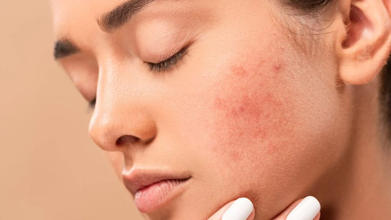 Skin Care: వర్షంలో చర్మం జిడ్డుగా ఉండి.. ముఖంపై మొటిమలు వస్తుంటే.. ఇలా చేస్తే చాలు..