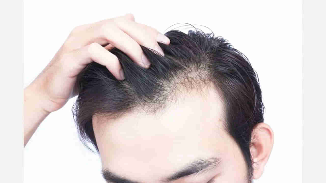 Hair Fall: వీటిని ఎక్కువగా తీసుకుంటే బట్టతలతో బాధపడాల్సిందే.. అందుకే దూరం పెట్టండి..