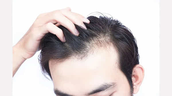 Hair Care: తలలో దురదతో తెగ ఇబ్బంది పడుతున్నారా.. ఈ హోం రెమెడీస్తో చెక్ పెట్టండిలా..