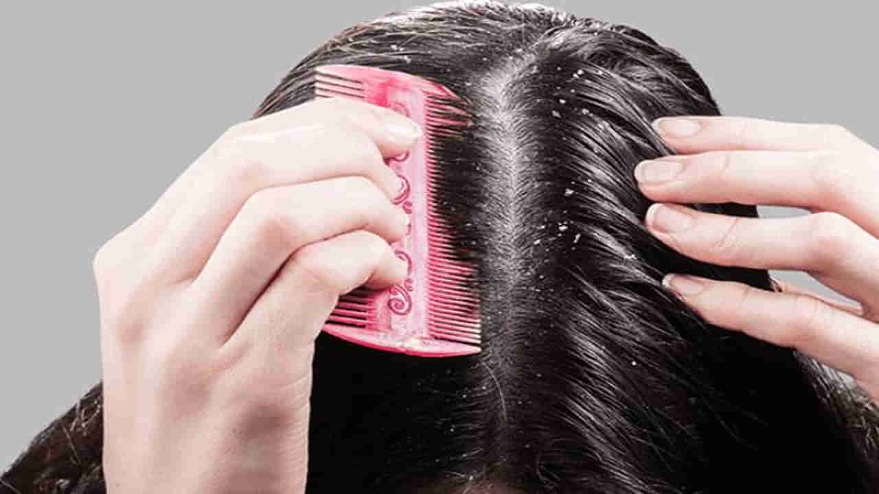 Hair care: విటమిన్ల లోపంతో జుట్టు ఊడిపోవడం, చుండ్రు సమస్యతో ఇబ్బంది పడుతున్నారా? ఇలా చేయండి