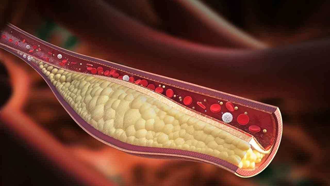 High Cholesterol: తరచుగా కాళ్లలో తిమ్మిర్లు వస్తున్నాయా? అయితే, మీ శరీరంలో ఈ సమస్య ఉన్నట్లే..!