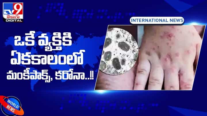 అరుదైన సంఘటన.. ఒకే వ్యక్తికి ఏకకాలంలో మంకీపాక్స్, కరోనా అరుదైన సంఘటన.. ఒకే వ్యక్తికి ఏకకాలంలో మంకీపాక్స్, కరోనా
