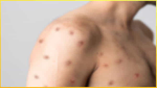 Monkeypox: మంకీపాక్స్ ఒకరి నుంచి మరొకరికి వ్యాపిస్తుందా..? నిపుణులు ఏమంటున్నారు..?
