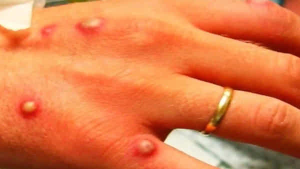 Chickenpox,Monkeypox: హడలెత్తిస్తున్న మంకీ పాక్స్.. వెంటాడుతున్న చికెన్ పాక్స్.. ఎలా గుర్తించాలో చెబుతున్న వైద్యులు..!!