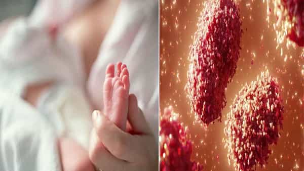 Monkeypox in US: అమెరికాలో తొలిసారిగా ఇద్దరు చిన్నారుల్లో వెలుగుచూసిన మంకీపాక్స్ లక్షణాలు..