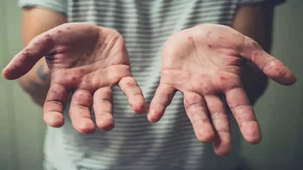 Monkeypox: భారత్లో దడ పుట్టిస్తున్న మంకీపాక్స్.. మూడో కేసు నమోదు.. ఎక్కడంటే..!