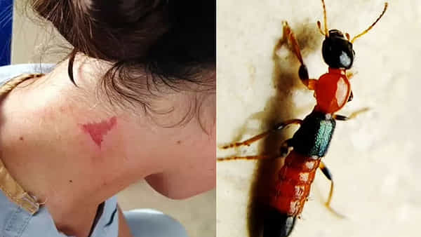Nairobi Flies: మరో వైరస్ ముప్పు.. 7 వేల కిలోమీటర్లు దాటుకుని భారత్లోకి వచ్చిన పెను విపత్తు.. ఇప్పటికే 100మందికి..!