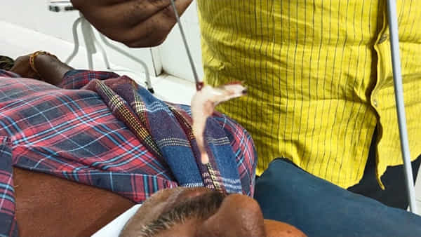 Eluru: చెరువులోకి దిగిన వ్యక్తి ముక్కులోకి దూరిన రొయ్య.. ఊపిరాడక ఉక్కిరిబిక్కిరి.. చివరకు
