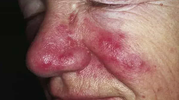 Rosacea: ఈ చర్మ వ్యాధితో బాధపడుతున్నారా..? మజ్జిగలో కరివేపాకు కలిసి తీసుకుంటే అద్భుతమైన ప్రయోజనాలు