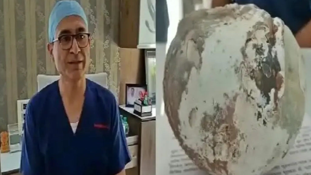 Stone Kidney