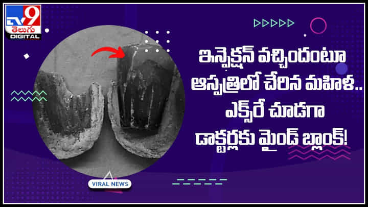 woman stomach: ఇన్ఫెక్షన్ వచ్చిందంటూ ఆస్పత్రిలో చేరిన మహిళ.. ఎక్స్రే చూడగా డాక్టర్లకు మైండ్ బ్లాంక్..! woman stomach: ఇన్ఫెక్షన్ వచ్చిందంటూ ఆస్పత్రిలో చేరిన మహిళ.. ఎక్స్రే చూడగా డాక్టర్లకు మైండ్ బ్లాంక్..!