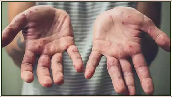 Monkeypox: మంకీపాక్స్ పేరును మార్చేందుకు డబ్ల్యూహెచ్వో పరిశీలన.. ఎందుకో తెలుసా?