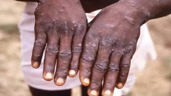 Monkeypox: మంకీపాక్స్ నుంచి కోలుకున్నా.. శరీరంలో వైరస్ అలాగే ఉంటుంది.. అధ్యయనంలో కీలక విషయాలు