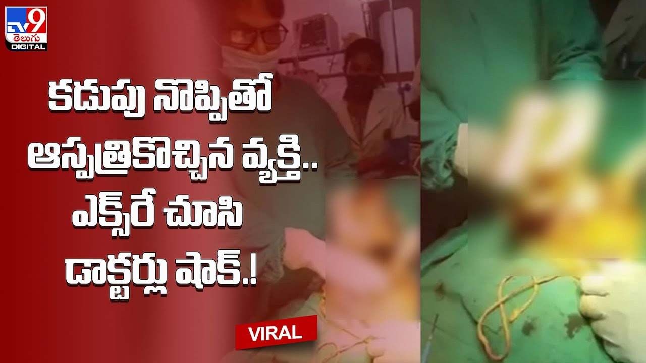 కడుపు నొప్పితో అస్పత్రికొచ్చిన వ్యక్తి.. ఎక్స్‌రే చూసి డాక్టర్లు షాక్ !!