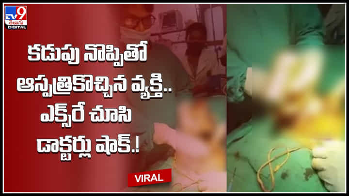 Viral Video: కడుపు నొప్పితో అస్పత్రికొచ్చిన వ్యక్తి.. ఎక్స్రే చూసి డాక్టర్లు షాక్.! రెండు గంటల పాటు వైద్యం.. Viral Video: కడుపు నొప్పితో అస్పత్రికొచ్చిన వ్యక్తి.. ఎక్స్రే చూసి డాక్టర్లు షాక్.! రెండు గంటల పాటు వైద్యం..