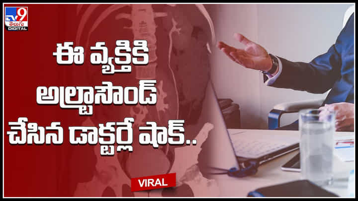 Ultrasound: కాన్పూర్లో వింత కేసు.. ఈ వ్యక్తికి అల్ట్రాసౌండ్ చేసిన డాక్టర్లకు షాక్.. వైరల్ అవుతున్న వీడియో.. Ultrasound: కాన్పూర్లో వింత కేసు.. ఈ వ్యక్తికి అల్ట్రాసౌండ్ చేసిన డాక్టర్లకు షాక్.. వైరల్ అవుతున్న వీడియో..
