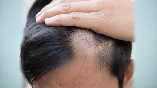 Hair Loss: చిన్న వయస్సులోనే బట్టతల వేధిస్తోందా.? అయితే ఇలా చేయండి..