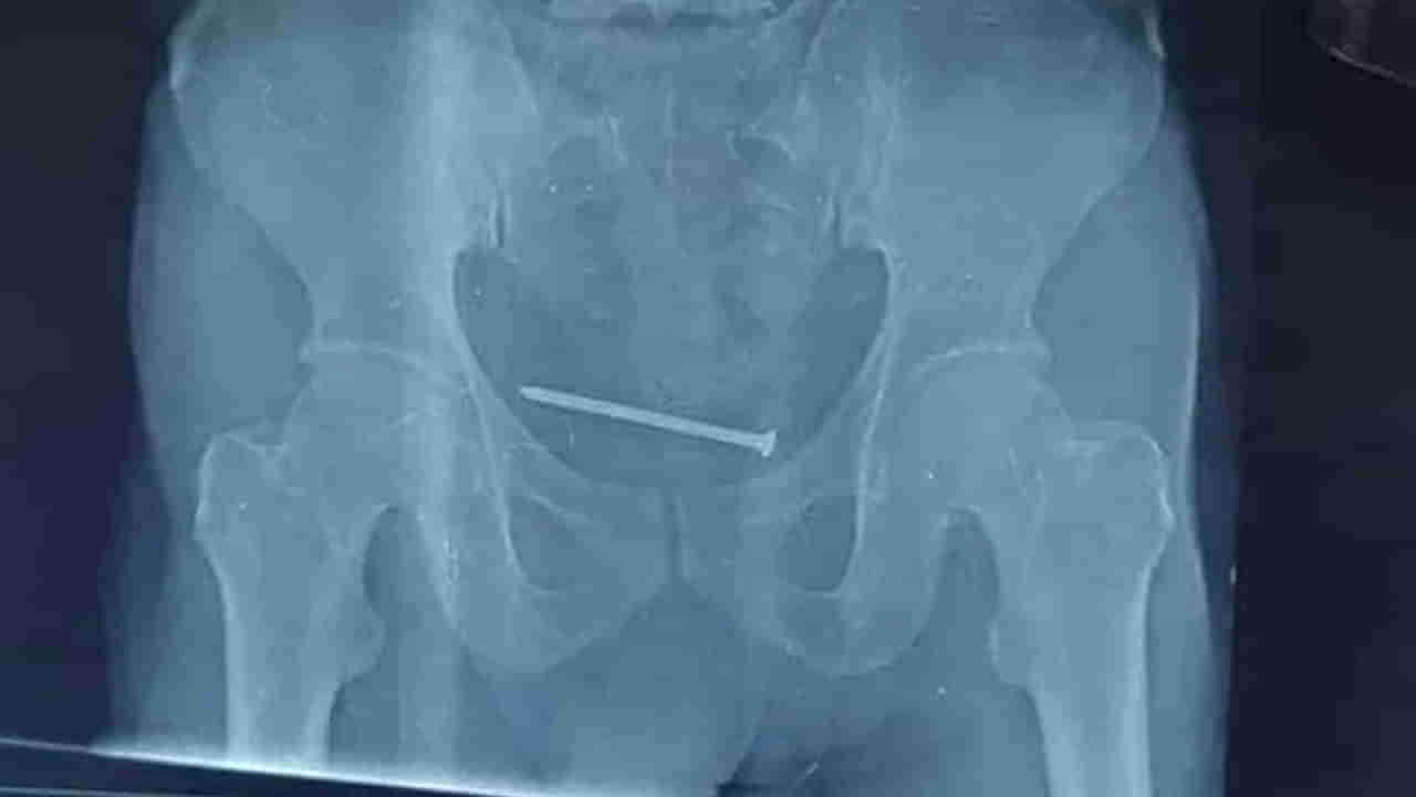 Viral: మూత్రాశయంలో తీవ్రమైన నొప్పితో అస్పత్రికెళ్లిన వ్యక్తి.. ఎక్స్‌రే చూసి డాక్టర్లు షాక్!