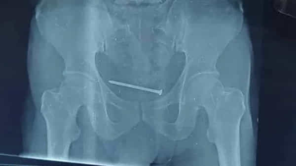 Viral: మూత్రాశయంలో తీవ్రమైన నొప్పితో అస్పత్రికెళ్లిన వ్యక్తి.. ఎక్స్రే చూసి డాక్టర్లు షాక్!