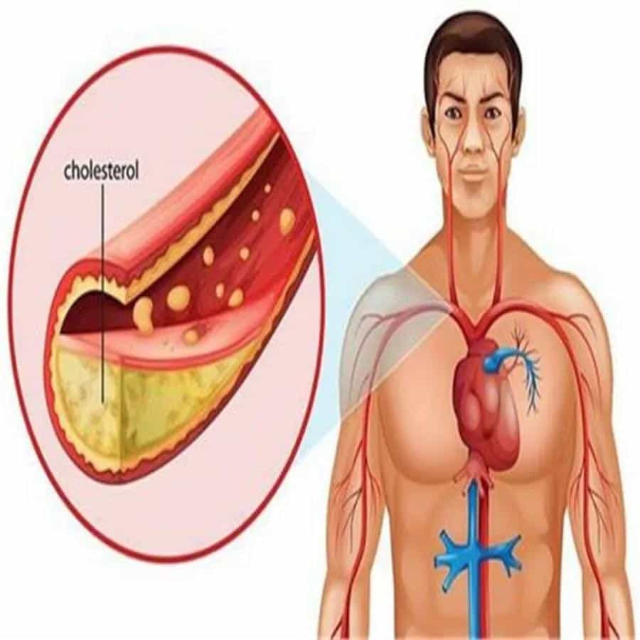 కొలెస్ట్రాల్ తగ్గించడం: గుడ్లు ఆరోగ్యానికి మేలు చేస్తాయి. అయితే గుడ్లను ఎక్కువగా తినేవారు.. అకస్మాత్తుగా ఆపడం ద్వారా, కొలెస్ట్రాల్ స్థాయి కూడా తగ్గుతుంది. కోడిగుడ్డు పచ్చసొనలో కొలెస్ట్రాల్ ఎక్కువగా ఉంటుందని పరిశోధనలో తేలింది. అటువంటి పరిస్థితిలో, గుడ్లను తినడం ఆపడం ద్వారా, చెడు కొలెస్ట్రాల్ స్థాయిని చాలా వరకు నియంత్రించవచ్చు.