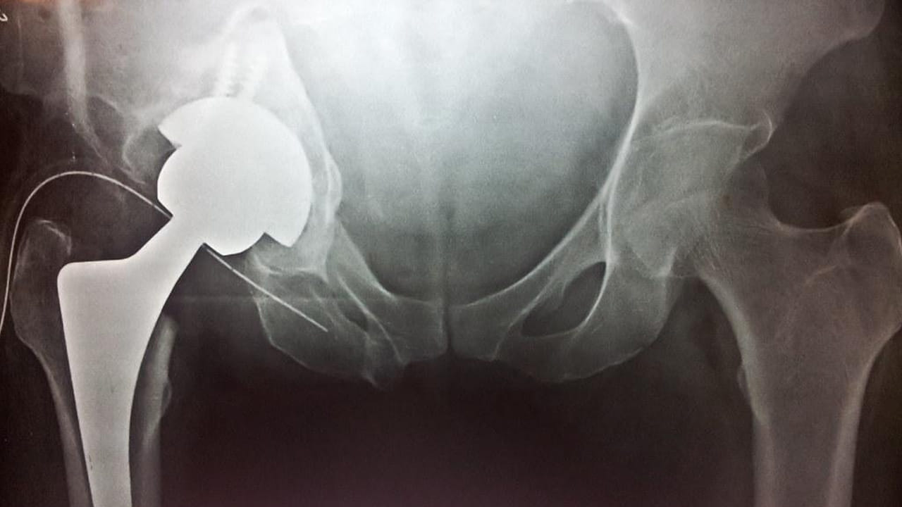 Osteoporosis: భారీగా పెరుగుతోన్న ఆస్టియోపోరోసిస్ బాధితులు.. వారికే ఎక్కువ ముప్పు.. తాజా అధ్యయనంలో షాకింగ్ విషయాలు