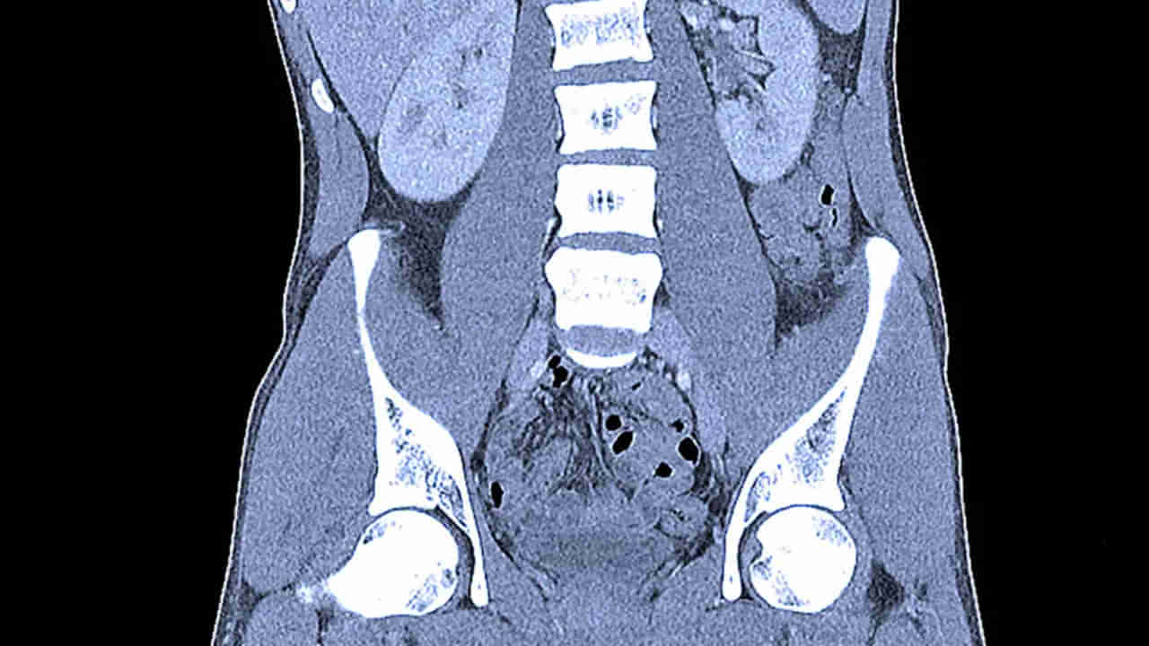 Viral: పొట్టలో నొప్పితో ఆస్పత్రికి వచ్చిన వ్యక్తి.. సీటీ స్కాన్ రిపోర్ట్ చూసి నిర్ఘాంతపోయిన డాక్టర్స్