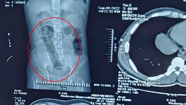 Viral: ఛీ.. ఇదేం పాడుపని.. కడుపునొప్పితో ఆస్పత్రికొచ్చిన యువకుడు.. ఎక్స్రే తీసి ఖంగుతిన్న డాక్టర్లు!