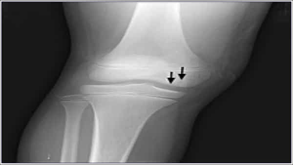Bone Diseases: కోవిడ్ తర్వాత ఎముకల్లో నొప్పి? ఈ ప్రమాదకరమైన వ్యాధికి కారణం కావచ్చు..!