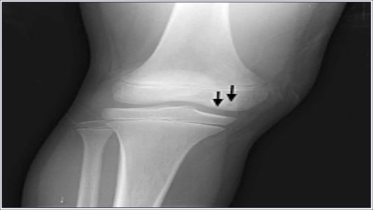 Bone Diseases: కోవిడ్ తర్వాత ఎముకల్లో నొప్పి? ఈ ప్రమాదకరమైన వ్యాధికి కారణం కావచ్చు..!