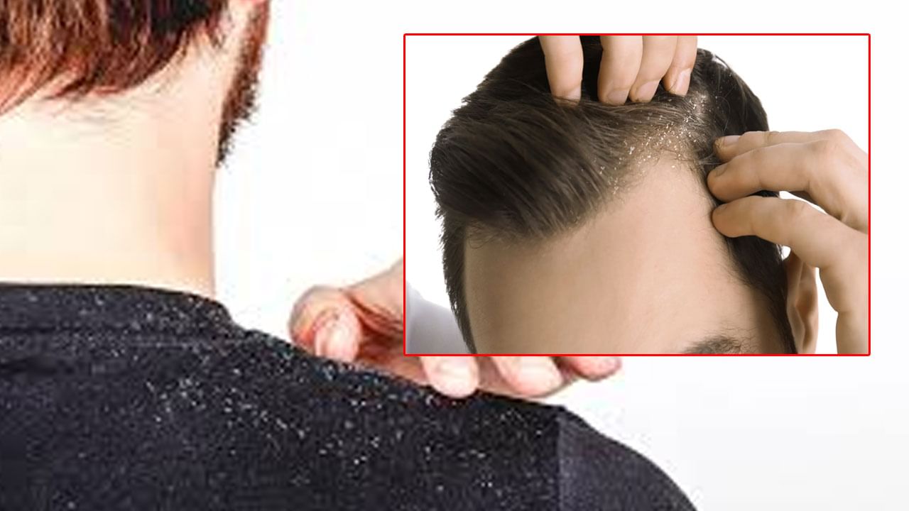 Dandruff Cure: చుండ్రుతో ఇబ్బంది పడుతున్నారా? మెంతులతో ఇలా చేస్తే ఆ సమస్యే ఉండదు..