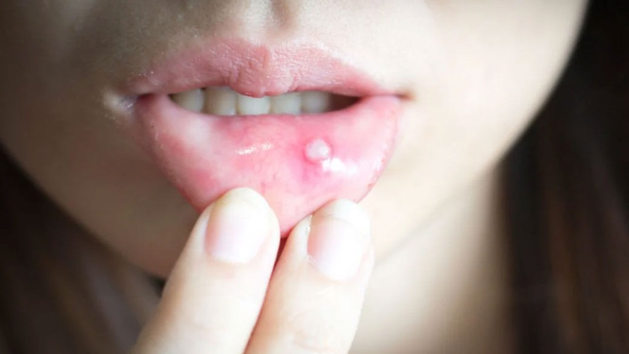Mouth Ulcers: నోట్లో పుండ్లు పడ్డాయా? బాధ భరించలేకపోతున్నారా? అయితే ఇంట్లో ఉండే వాటిని ఎంచక్కా నయం చేసుకోండి!