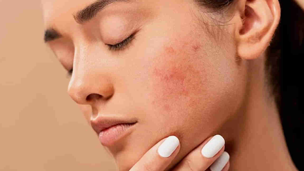 Beauty Tips: నల్లటి మచ్చలు మీ ముఖారవిందాన్ని పాడు చేస్తున్నాయా? వెంటనే వీటిని ట్రే చేయండి..