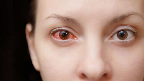 Pink Eye: కళ్లు గులాబీ రంగులోకి మారాయా..? అయితే బీ అలెర్ట్.. వ్యాధి, దాని లక్షణాలు ఏమిటో తెలుసుకోండి..